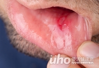 嘴破長白斑 竟是癌前病變!