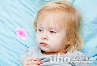 女童染麻疹 醫:自主管理18天