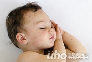 幼兒冒紅疹 醫:多數為良性