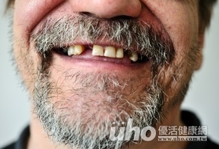 咬合困難 缺牙不補恐致關節障礙