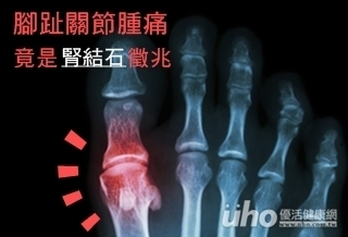 腳趾關節腫痛 竟是腎結石徵兆