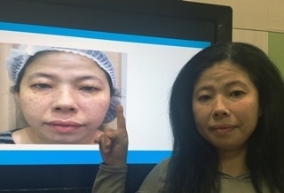 忘防曬 清明掃墓帶回兩片肝斑