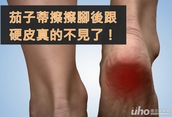 茄子蒂擦擦腳後跟 硬皮不見了!