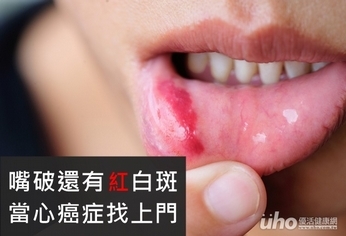 嘴破還有紅白斑 當心癌症找上門