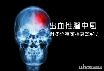 出血性腦中風 針灸治療可提高認知力