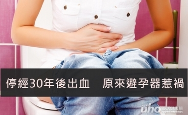 停經30年後出血 原來避孕器惹禍