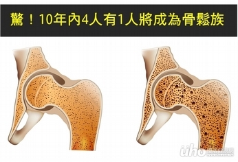 驚!10年內4人有1人將成為骨鬆族