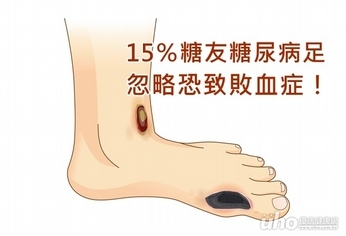 15%糖友糖尿病足 忽略恐致敗血症!