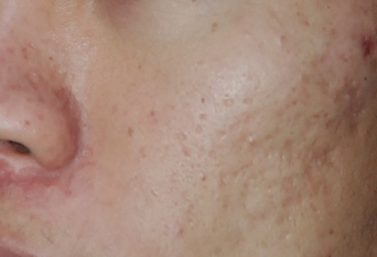 點狀痘疤煥膚術 搭配飛梭雷射效果加倍