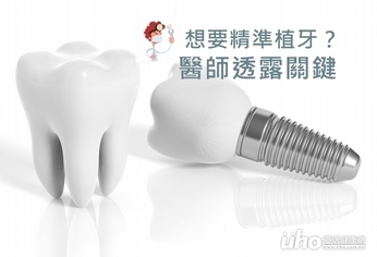 想要精準植牙?醫師透露關鍵