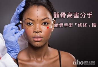 顴骨高害分手 縮骨手術「修修」臉
