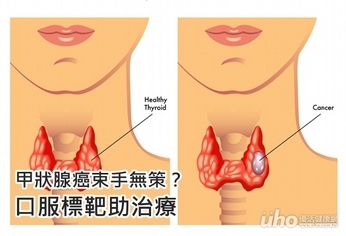 甲狀腺癌束手無策?口服標靶助治療