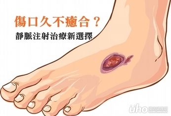 傷口久不癒合?靜脈注射治療新選擇