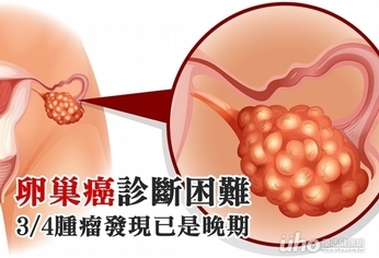 卵巢癌診斷困難 3/4腫瘤發現已是晚期