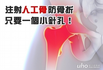 注射人工骨防骨折 只要一個小針孔!