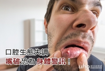 口腔生態失調 嘴破恐為身體警訊!