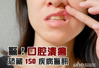 驚!口腔潰瘍恐藏150疾病警訊