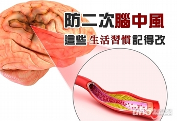 防二次腦中風 這些生活習慣記得改
