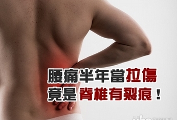 腰痛半年誤當拉傷 竟是脊椎裂痕害的!