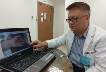 幼童玻璃藏手掌8周 洗澡喊痛才知道