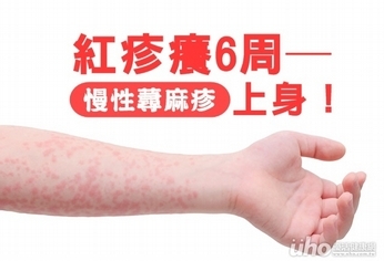 紅疹癢6周 慢性蕁麻疹上身!