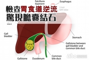 檢查胃食道逆流 驚現膽囊結石