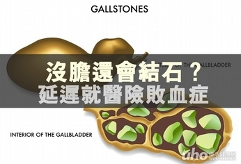 沒膽還會結石?延遲就醫險敗血症