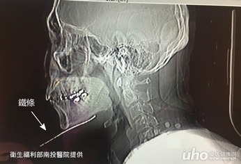 割草驚險記 鐵條差一吋險穿喉