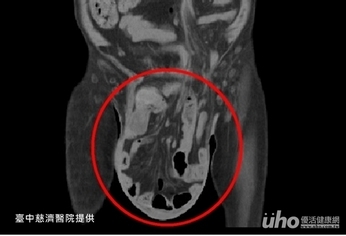 疝氣拖10年 陰囊腫成18公分大