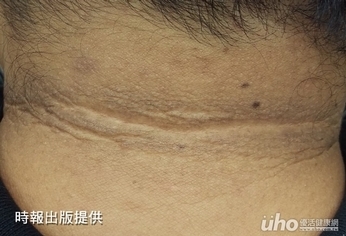 這裡太黑,小心「黑色棘皮症」上身!