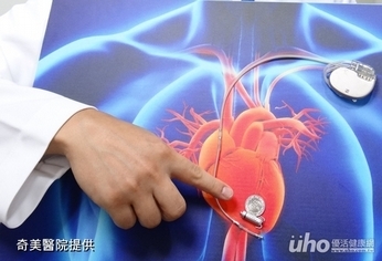 心跳休止3.8秒 膠囊節律器助改善