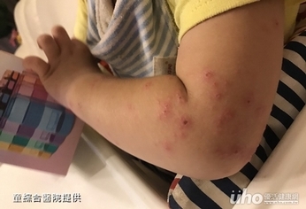 地上玩染細菌　2歲童險蜂窩性組織炎