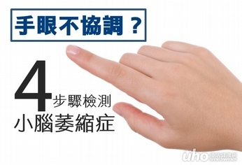 手眼不協調?4步驟檢測小腦萎縮症