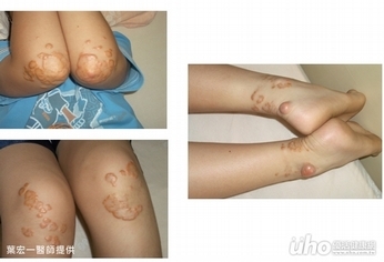 女大生膝蓋冒出脂肪瘤 高膽固醇害的