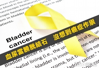 血便誤當結石 沒想到竟是癌症作祟