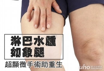 淋巴水腫如象腿 超顯微手術助重生