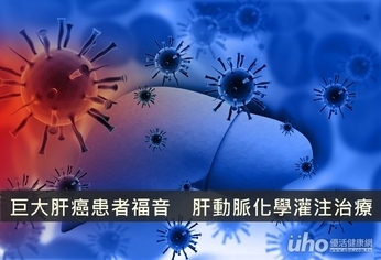 巨大肝癌患者福音 肝動脈化學灌注治療