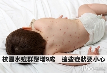 校園水痘群聚增9成 這些症狀要小心