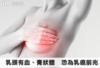 乳頭有血、膏狀體 恐為乳癌前兆