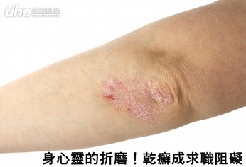 身心靈的折磨!乾癬成求職阻礙