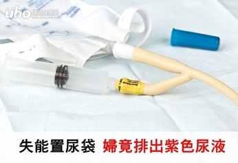 失能置尿袋 婦竟排出紫色尿液