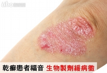 乾癬患者福音 生物製劑緩病徵