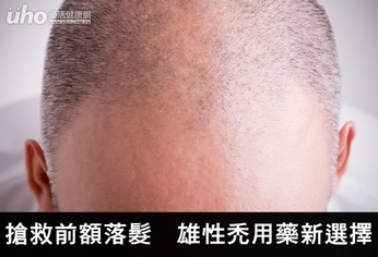 搶救前額落髮 雄性禿用藥新選擇