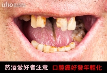 菸酒愛好者注意 口腔癌好發年輕化