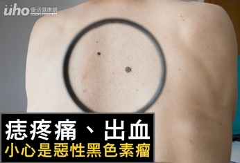 痣疼痛、出血 小心是惡性黑色素瘤