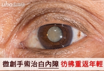 微創手術治白內障 彷彿重返年輕