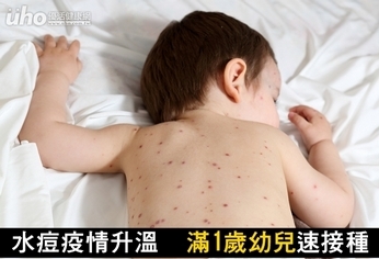 水痘疫情升溫!滿1歲幼兒速接種
