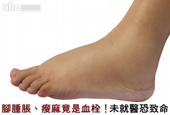 腳腫脹、痠麻竟是血栓!未就醫恐致命