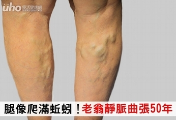 腿像爬滿蚯蚓!老翁靜脈曲張50年