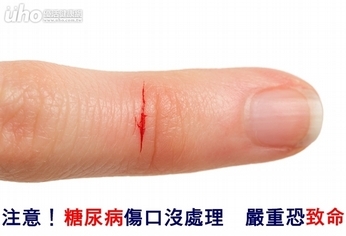 注意!糖尿病傷口沒處理 嚴重恐致命